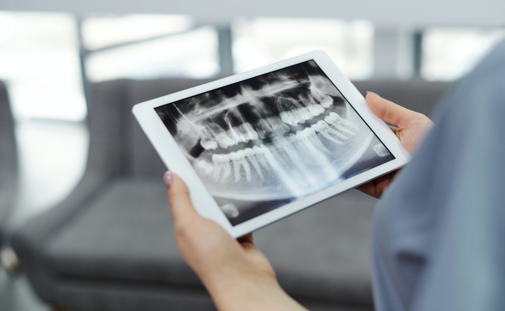 Signs You May Need Dental Implants